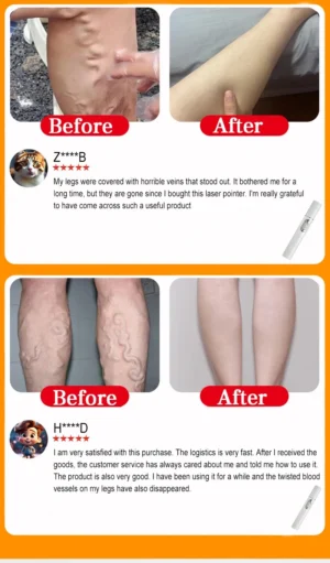 Varicose Vein Lampshade Therapy Effective Relief Of Dilated Vasculitis In The Legs Phlebitis Improved Blood Circulation New - Image 5