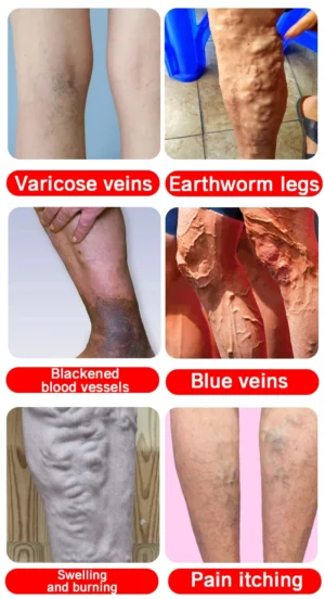 Varicose Vein Lampshade Therapy Effective Relief Of Dilated Vasculitis In The Legs Phlebitis Improved Blood Circulation New - Image 7