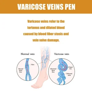 Lampshade Therapy Leg Repair Pen Relieves Leg Bulge Discomfort Improving Blood Circulation Varicose Veins Pen Skin Care Product - Image 6