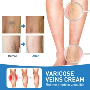Lampshade Therapy Leg Repair Pen Relieves Leg Bulge Discomfort Improving Blood Circulation Varicose Veins Pen Skin Care Product - Image 7