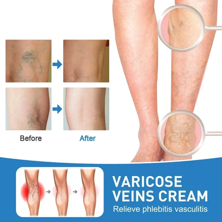 Lampshade Therapy Leg Repair Pen Relieves Leg Bulge Discomfort Improving Blood Circulation Varicose Veins Pen Skin Care Product - Image 7