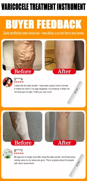 Varicose Vein Lampshade Therapy Effective Relief Of Dilated Vasculitis In The Legs Phlebitis Improved Blood Circulation New - Image 6