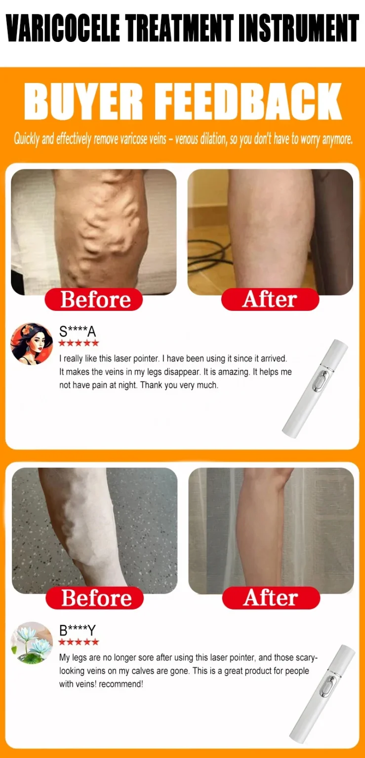 Varicose Vein Lampshade Therapy Effective Relief Of Dilated Vasculitis In The Legs Phlebitis Improved Blood Circulation New - Image 6