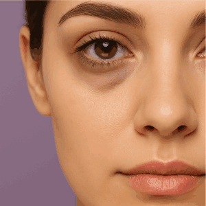 Dark circles