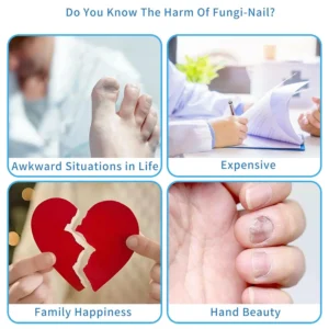 Nail Fungal Light Device Fungal Discolored Remover Portable Nail Fungal Eradication Device for Thick Toenails and Fingernails - Image 3