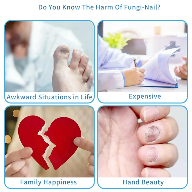 Nail Fungal Light Device Fungal Discolored Remover Portable Nail Fungal Eradication Device for Thick Toenails and Fingernails - Image 3