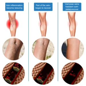 Laser Treatment for Varicose Veins Spider Legs Phlebitis Vasculitis Relieve Leg Pain Improve Blood Circulation - Image 3