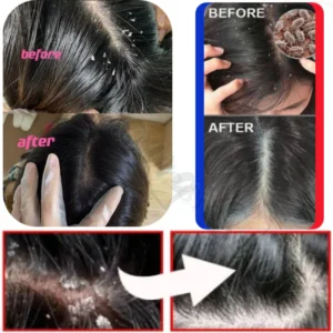 Selenium Disulfide Anti-Dandruff Shampoo Deep Cleansing Scalp Oil Control Anti-Dandruff Anti-Itching Smoothing Shampoo 320ml - Image 5