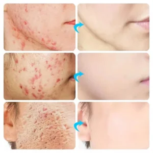 Acne Cream For Face Pimples Remover Treatment Shrink Pores Oil Control Lighten Acne Marks Whitening Smoothing Facial Skin Care - Image 2
