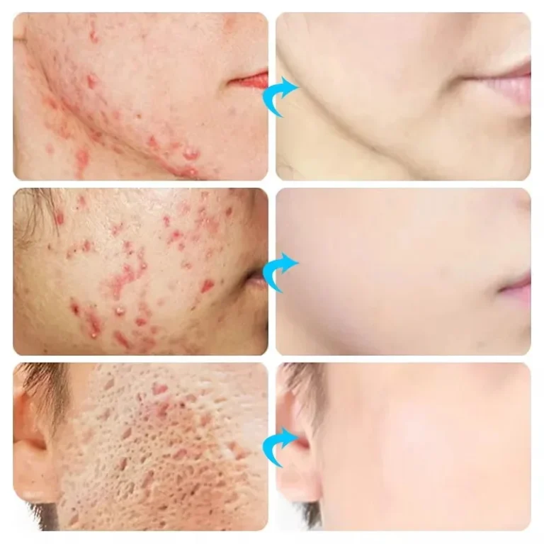 Acne Cream For Face Pimples Remover Treatment Shrink Pores Oil Control Lighten Acne Marks Whitening Smoothing Facial Skin Care - Image 2