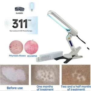 UV 311nm Ultraviolet Phototherapy Device Uses Philips Lamp UVB To Treat Vitiligo, Psoriasis, White Spots And Skin Diseases - Image 3