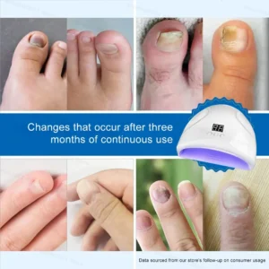 Nail Fungal Laser Treatment Device Repair Anti Infection Paronychia Onychomycosis Ingrown Toenail Foot Care Essence - Image 4