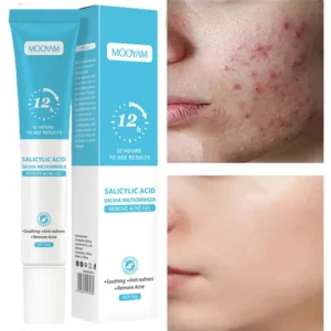 Acne Cream For Face Pimples Remover Treatment Shrink Pores Oil Control Lighten Acne Marks Whitening Smoothing Facial Skin Care
