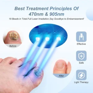 Nail Fungal Laser Treatment Device Repair Anti Infection Paronychia Onychomycosis Ingrown Toenail Foot Care Essence - Image 3