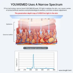 UV 311nm Ultraviolet Phototherapy Device Uses Philips Lamp UVB To Treat Vitiligo, Psoriasis, White Spots And Skin Diseases - Image 3