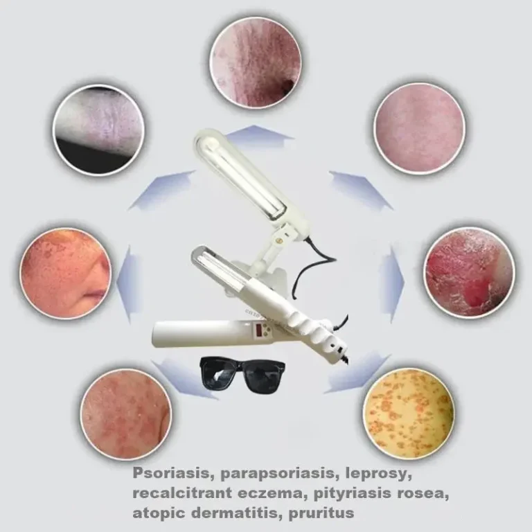 UV 311nm Ultraviolet Phototherapy Device Uses Philips Lamp UVB To Treat Vitiligo, Psoriasis, White Spots And Skin Diseases - Image 6