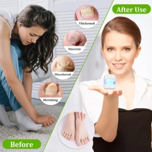 Repair Fast Nail Fungus Onychomycosis Fungus Nail Laser Device Fungus Cleaning Laser Device Remove Nail Fungus Cure Ingrown Tool - Image 5