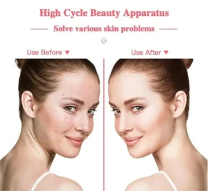 Professional 4-in-1 LED Therapy Mask & Argon Light Facial Device - Acne Treatment, Anti-Aging, Skin Rejuvenation Beauty Machine - Image 2