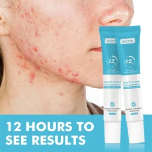 Acne Cream For Face Pimples Remover Treatment Shrink Pores Oil Control Lighten Acne Marks Whitening Smoothing Facial Skin Care - Image 3