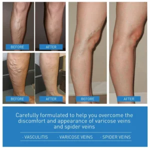Laser Treatment for Varicose Veins Spider Legs Phlebitis Vasculitis Relieve Leg Pain Improve Blood Circulation - Image 2