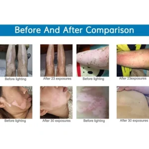 Get Clear Skin with UVB Phototherapy Narrow 311nm UV Lamp: Ideal for Psoriasis and Vitiligo - Image 4