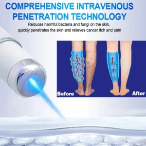 Laser Treatment for Varicose Veins Spider Legs Phlebitis Vasculitis Relieve Leg Pain Improve Blood Circulation - Image 5