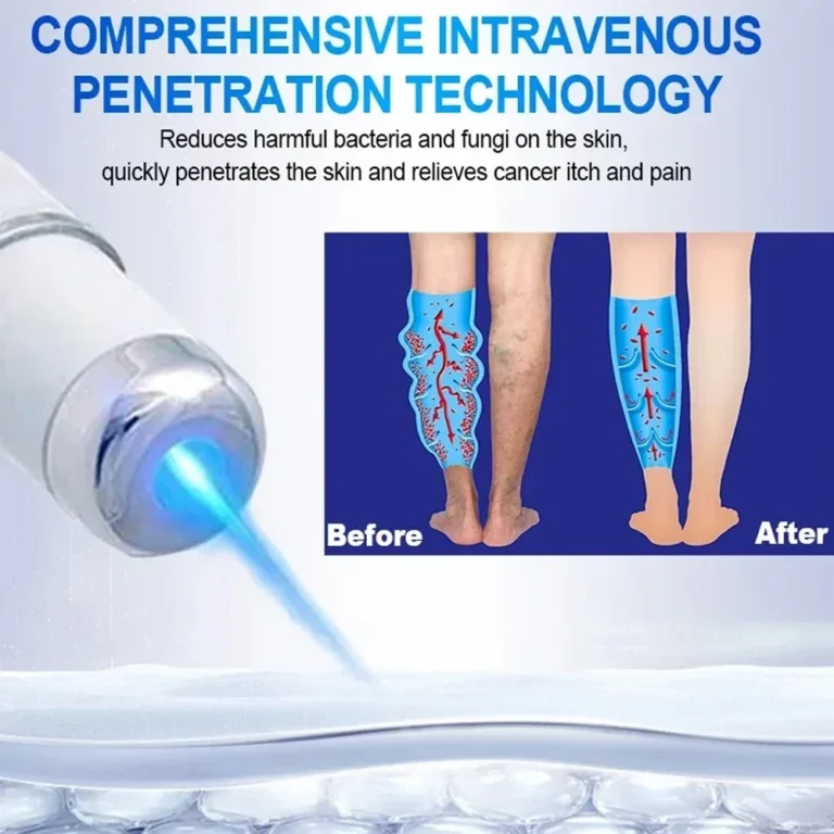 Laser Treatment for Varicose Veins Spider Legs Phlebitis Vasculitis Relieve Leg Pain Improve Blood Circulation - Image 5