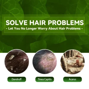 100ml Eelhoe Shampoo Anti-Itching Shampoos Anti-Dandruff Anti-Itching Shampoo Anti-Shedding Refreshing Shampoo Profissional - Image 3