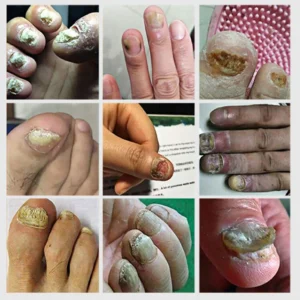 Nail Fungal Laser Treatment Device Repair Anti Infection Paronychia Onychomycosis Ingrown Toenail Foot Care Essence - Image 2