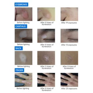 UV 311nm Ultraviolet Phototherapy Device Uses Philips Lamp UVB To Treat Vitiligo, Psoriasis, White Spots And Skin Diseases - Image 4