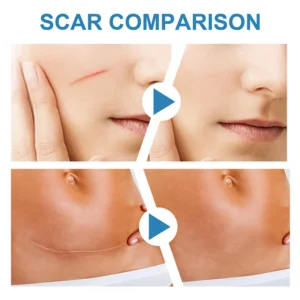 Laser therapy Keloid scar Laser Therapy Leg Repair Pen Reduce Legs Imcomfortable Improving Blood Circulation Varicose Veins Pen - Image 2