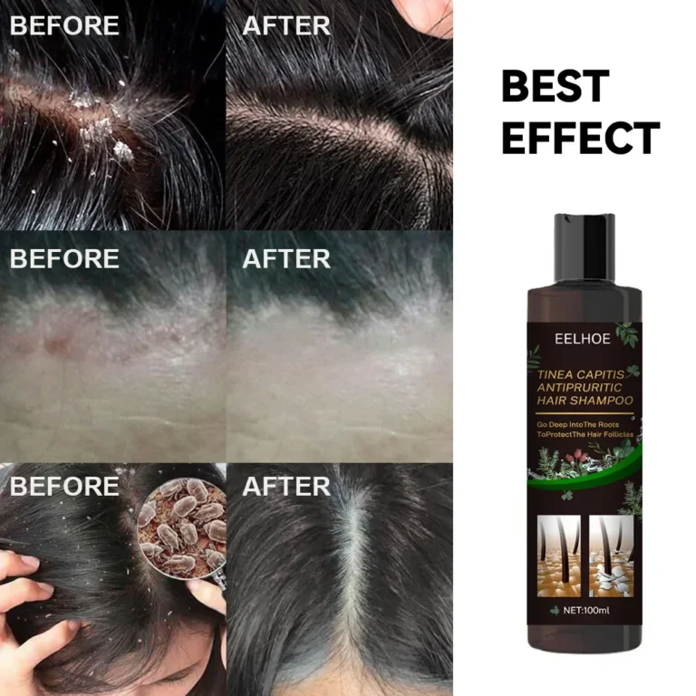 100ml Eelhoe Shampoo Anti-Itching Shampoos Anti-Dandruff Anti-Itching Shampoo Anti-Shedding Refreshing Shampoo Profissional - Image 6