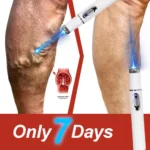 Laser Treatment for Varicose Veins Spider Legs Phlebitis Vasculitis Relieve Leg Pain Improve Blood Circulation