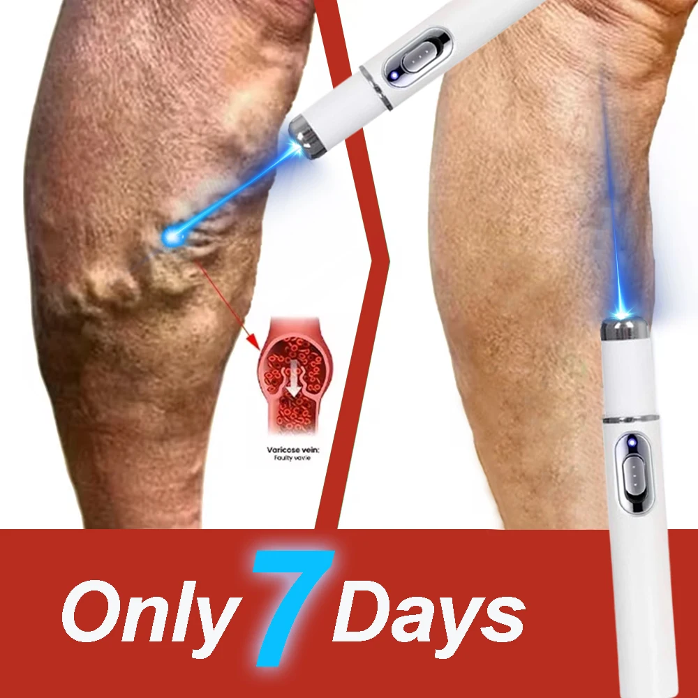 Laser Treatment for Varicose Veins Spider Legs Phlebitis Vasculitis Relieve Leg Pain Improve Blood Circulation