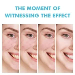 Acne Cream For Face Pimples Remover Treatment Shrink Pores Oil Control Lighten Acne Marks Whitening Smoothing Facial Skin Care - Image 4
