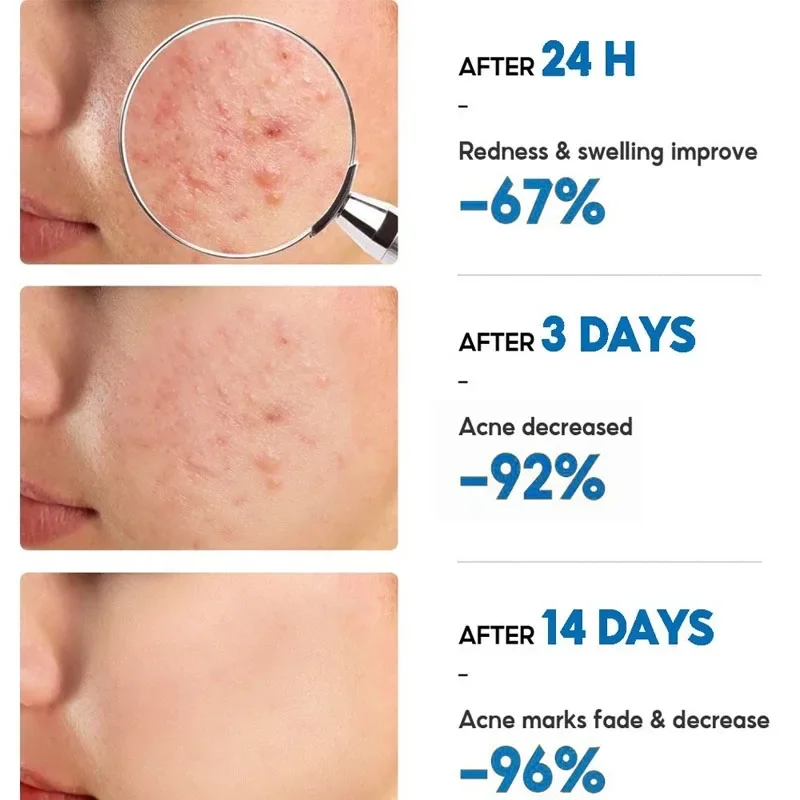 Salicylic Acid Acne Removal Cream Anti-Acne Repair Redness Pimple Spots Deep Cleaning Pore Oil Control Moisturizing Skin Care - Image 4
