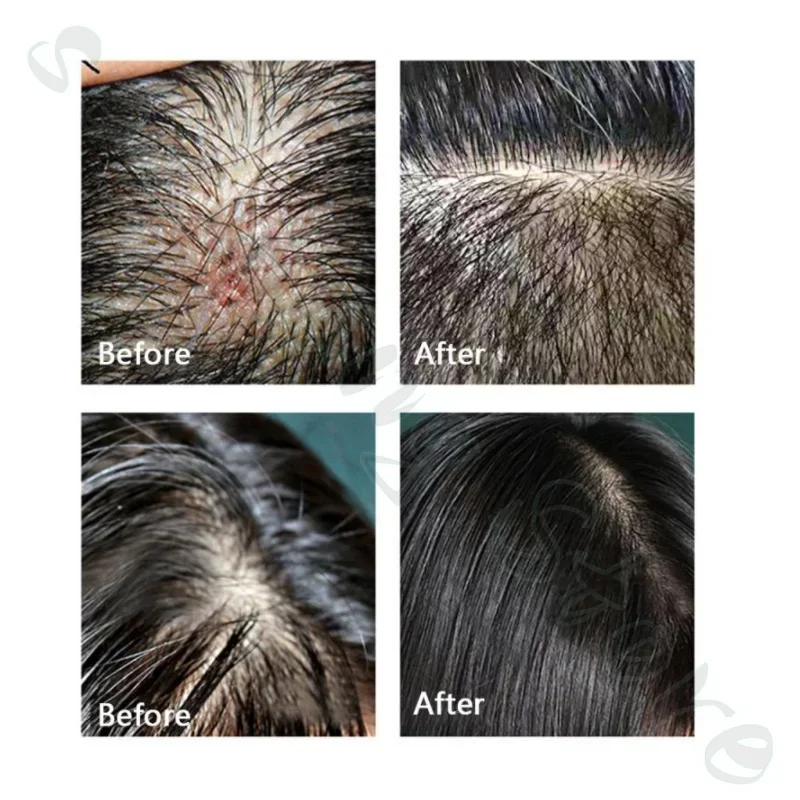 Selenium Sulfide Antipruritic Shampoo Refreshing Oil Control Deep Cleansing to Remove Hair Follicles from Scalp Pimples 200ml - Image 5