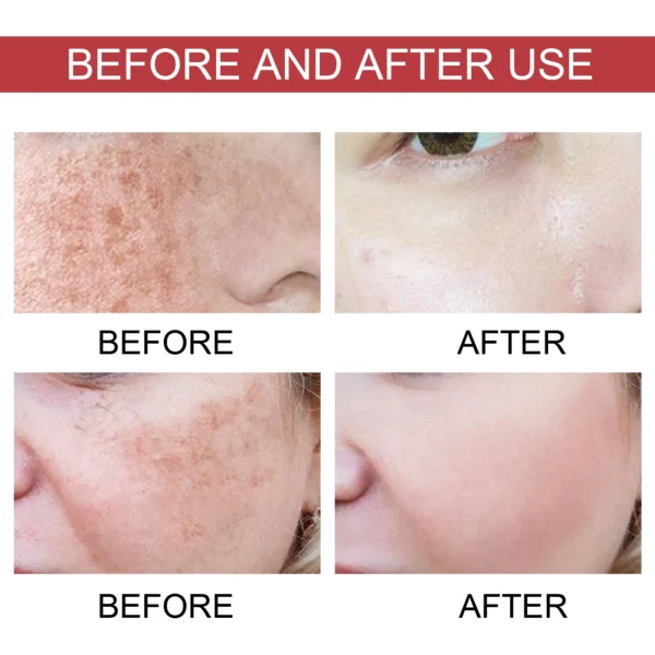 Niacinamide Tranexamic Dark Correcting Essence For Post-Acne Marks Acne Hyperpigmentation And Even Skin Tone Facial CorrectSerum - Image 5