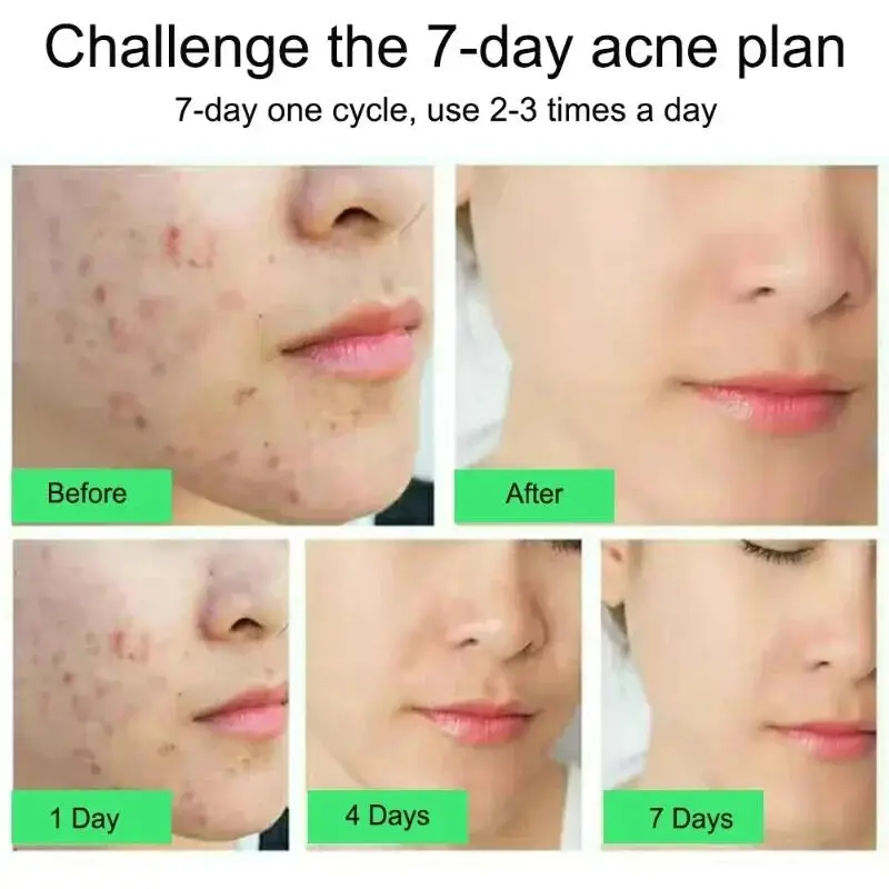 Salicylic Acid Acne Removal Cream Anti-Acne Repair Redness Pimple Spots Deep Cleaning Pore Oil Control Moisturizing Skin Care - Image 2