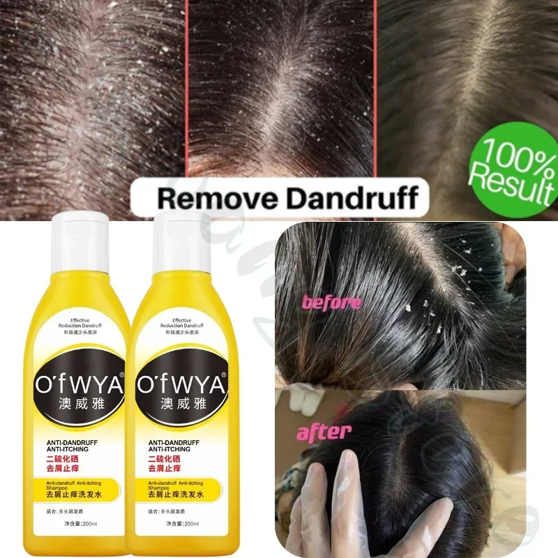 Selenium Sulfide Antipruritic Shampoo Refreshing Oil Control Deep Cleansing to Remove Hair Follicles from Scalp Pimples 200ml - Image 3