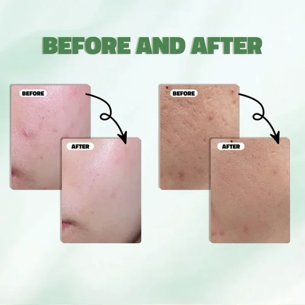 1/2/5Pcs Korean Redness Soothing Clarifying Serum,Azelaic Acid 10 Hyaluron Sensitive Skin Facial Ampoule,Niacinamide,Spot Care - Image 4