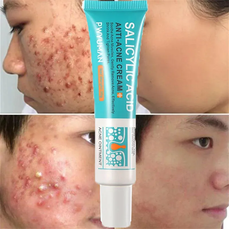 Salicylic Acid Acne Removal Cream Anti-Acne Repair Redness Pimple Spots Deep Cleaning Pore Oil Control Moisturizing Skin Care - Image 3