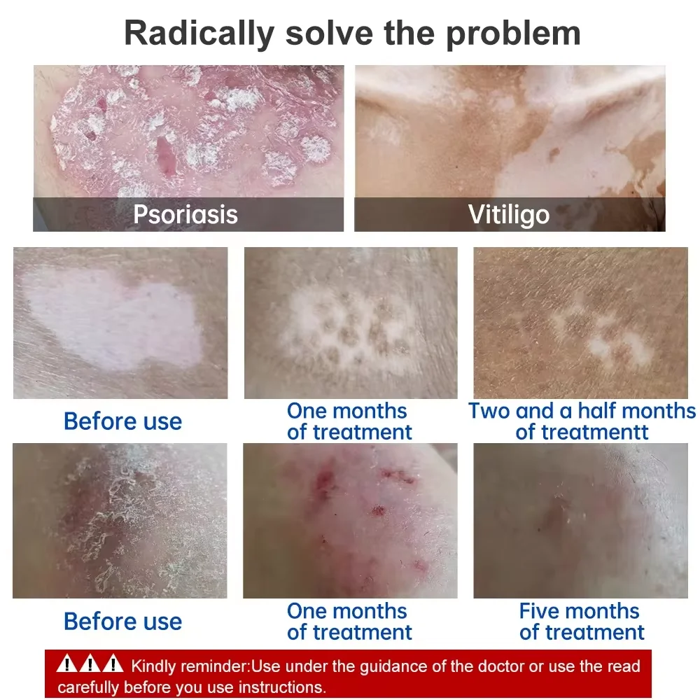 UVB Lamp for Therapy Vitiligo Psoriasis Skin Treatment Light 311nm Narrowband Ultraviolet uv Phototherapy Instrument - Image 5