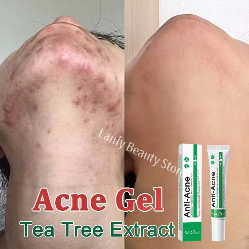 Salicylic Acid Acne Treatment Face Cream Repair Pimple Spots Deep Cleaning Pore Anti-acne Scar Oil Control Moisturizer Skin Care - Image 3