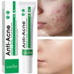 Salicylic Acid Acne Treatment Face Cream Repair Pimple Spots Deep Cleaning Pore Anti-acne Scar Oil Control Moisturizer Skin Care