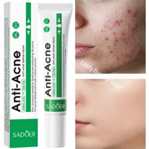 Salicylic Acid Acne Treatment Face Cream Repair Pimple Spots Deep Cleaning Pore Anti-acne Scar Oil Control Moisturizer Skin Care