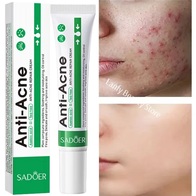 Salicylic Acid Acne Treatment Face Cream Repair Pimple Spots Deep Cleaning Pore Anti-acne Scar Oil Control Moisturizer Skin Care