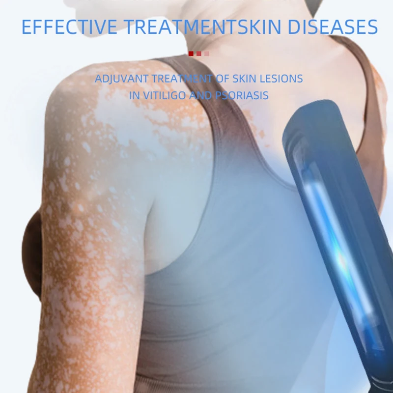 UVB Lamp for Therapy Vitiligo Psoriasis Skin Treatment Light 311nm Narrowband Ultraviolet uv Phototherapy Instrument - Image 2