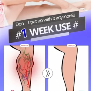 2025 Hot sale Vein blue light tool, more discounts on sets Leg care tools say goodbye to varicose veins