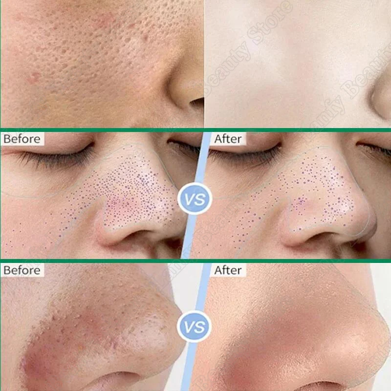 Salicylic Acid Pore Clearing Cream Shrink Pores Remove Blackheads Acne Brighten Moisturizing Smooth Skin Care Korean Products - Image 3